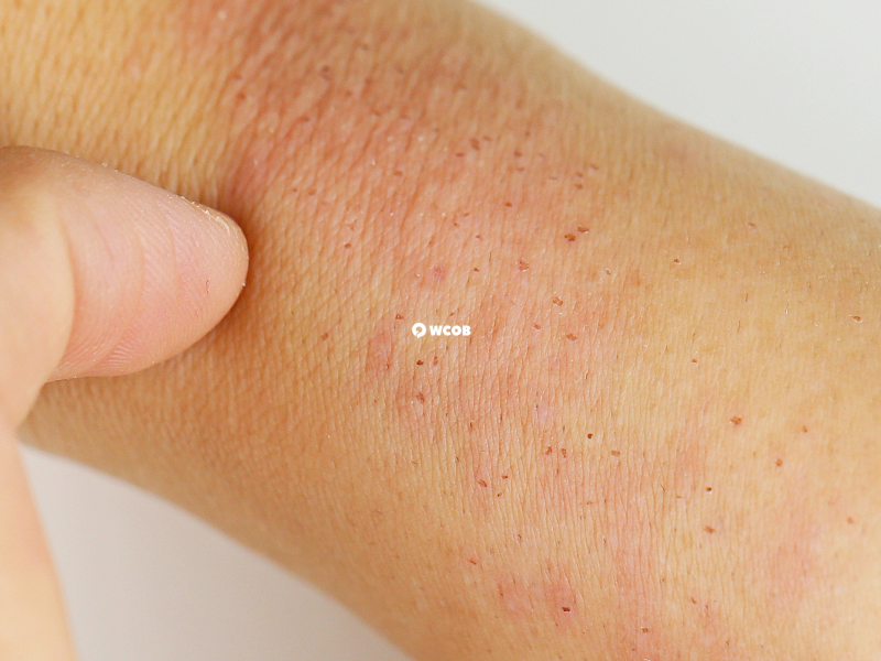 皮肤过敏是很多人都会遇到的情况