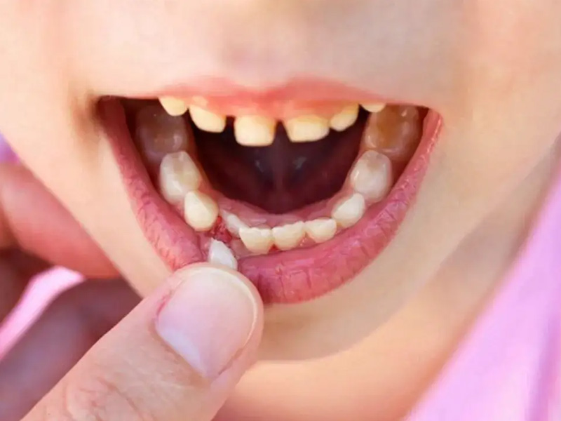 儿童一般从6岁开始换牙齿