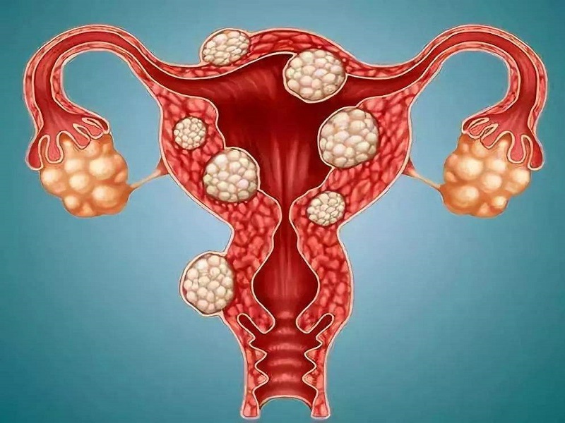 子宫肌瘤影响女性生育